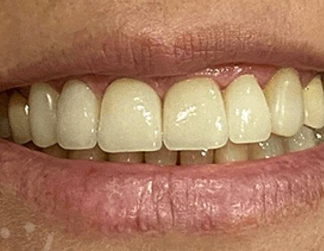 Dental Crowns After 3