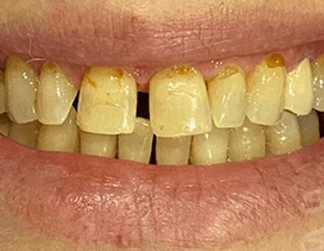 Dental Crowns Before 3