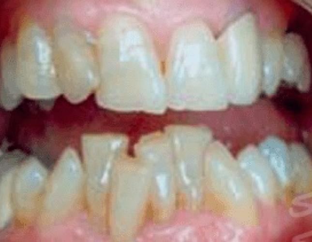 dentalbridgesbefore dentalbridgesbefore