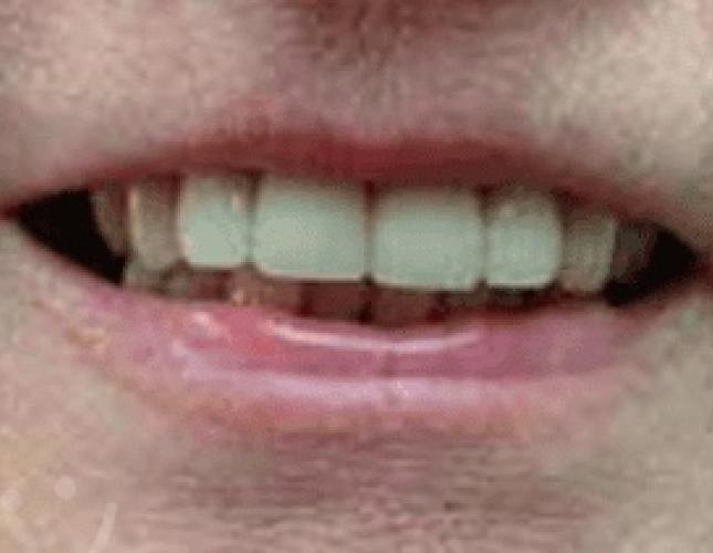 Dental Crowns After 1 Dental Crowns After 1