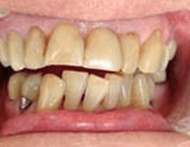 Dental Crowns Before 1