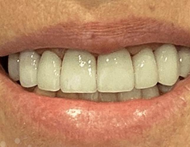 Dental Crowns After 2