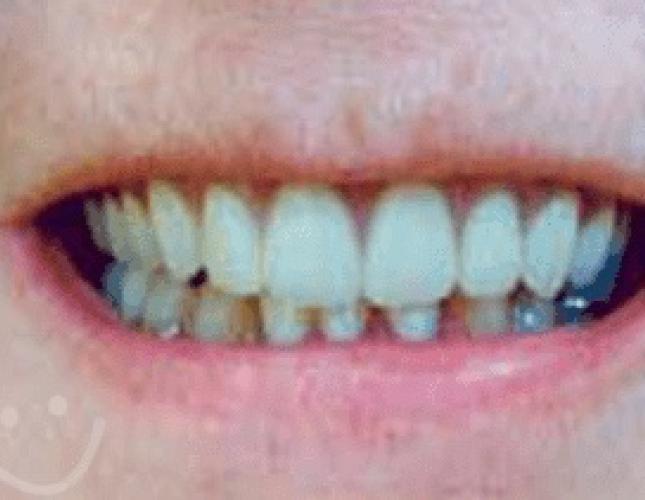 Dentures After Dentures After
