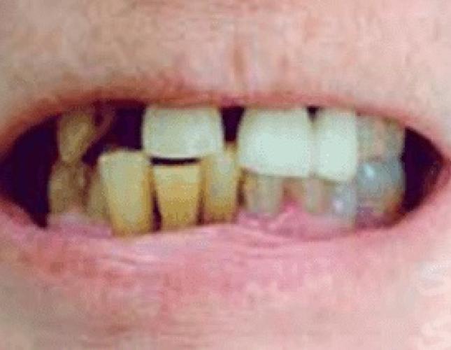 Dentures Before Dentures Before