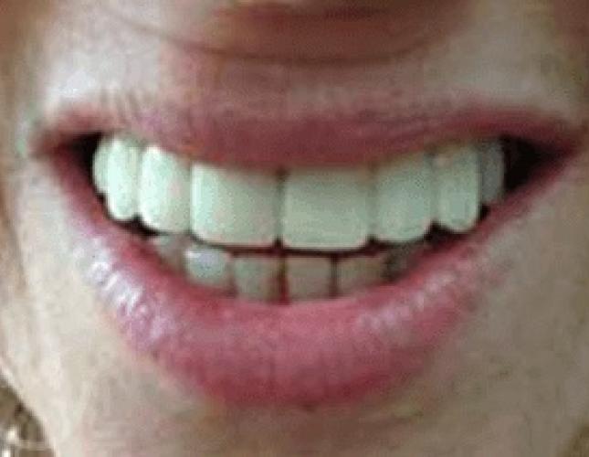 Implant Bridges after Implant Bridges after