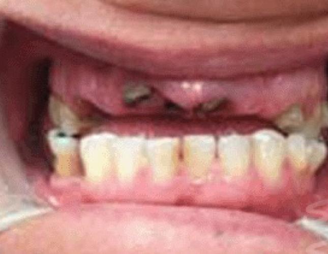 Implant Bridges before Implant Bridges before