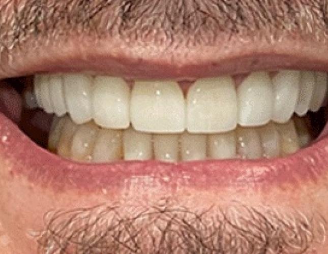 Implants After Implants After