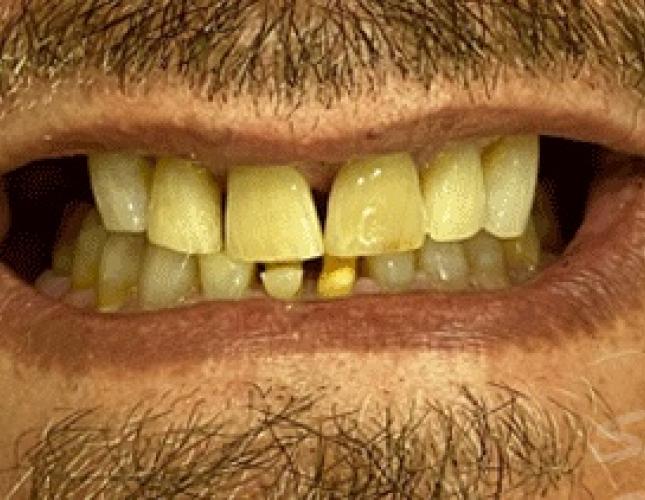 Implants Before Implants Before