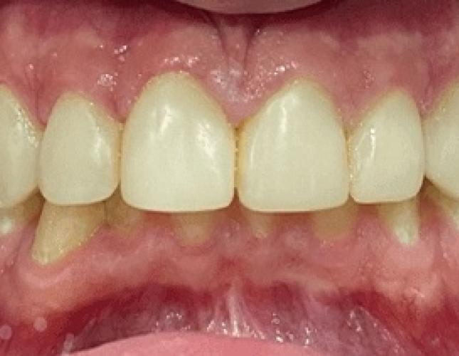 Smile makeover after Smile makeover after