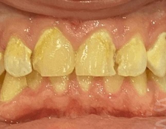 Smile makeover before Smile makeover before
