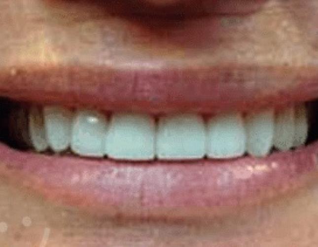 Veneers After 1