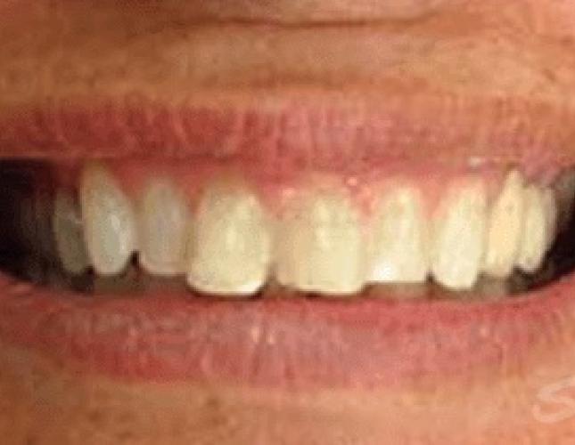 Veneers Before 1