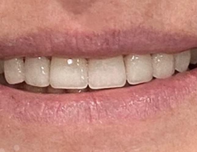 Veneers After 2 Veneers After 2
