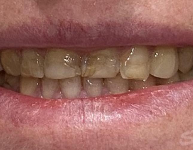 Veneers Before 2 Veneers Before 2