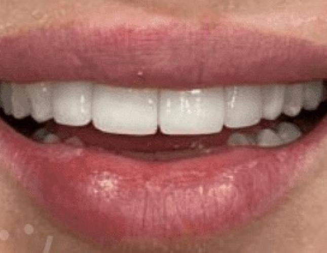 Veneers 3 after