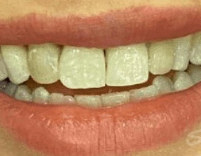 Veneers 3 before