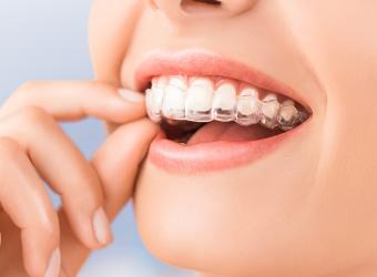 Clear Teeth Aligners