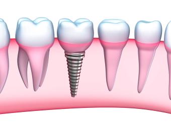 Tooth Implant Process