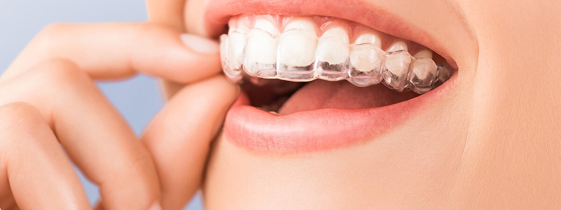 Clear teeth aligners