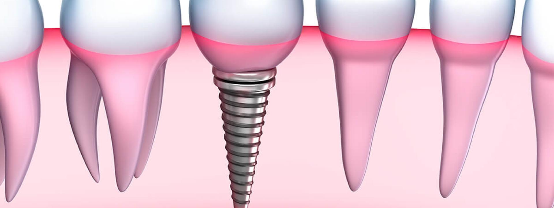 Tooth implant process